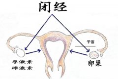 闭经患者在生活中应注意的事项?